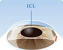 レンズを挿入する