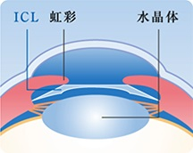 片方の目も同じ施術をする