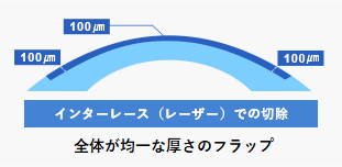 インターレース（レーザー）での切除