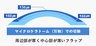 マイクロケラトーム（刃物）での切除