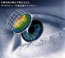 エキシマレーザー