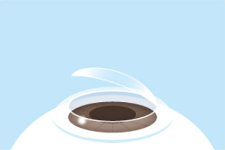 フラップを作製