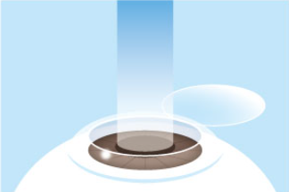 エキシマレーザーを照射し、近視・遠視・乱視を矯正